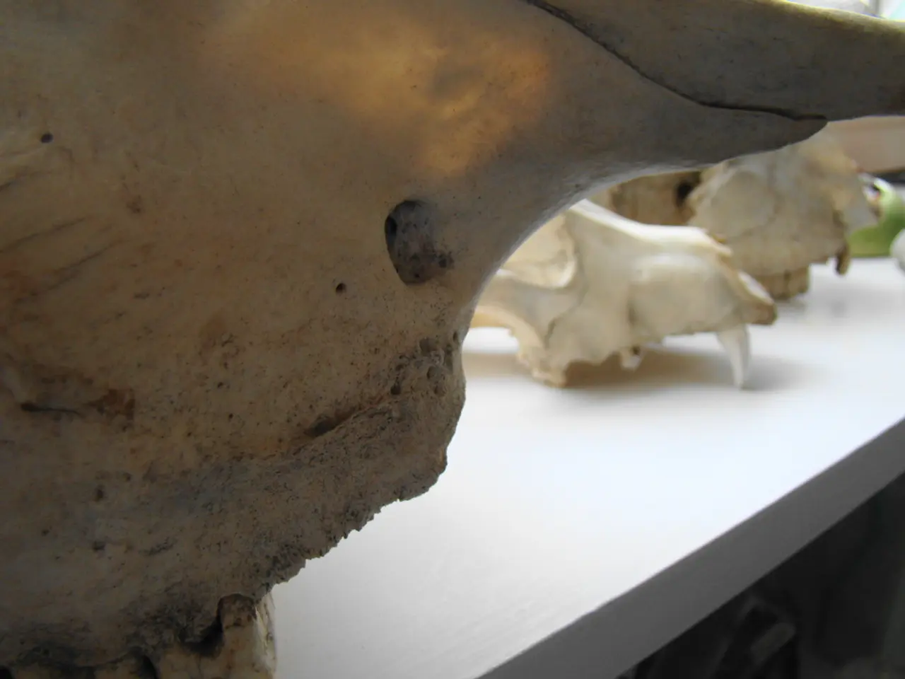 Brain tumor, specifically a type known as Meningioma