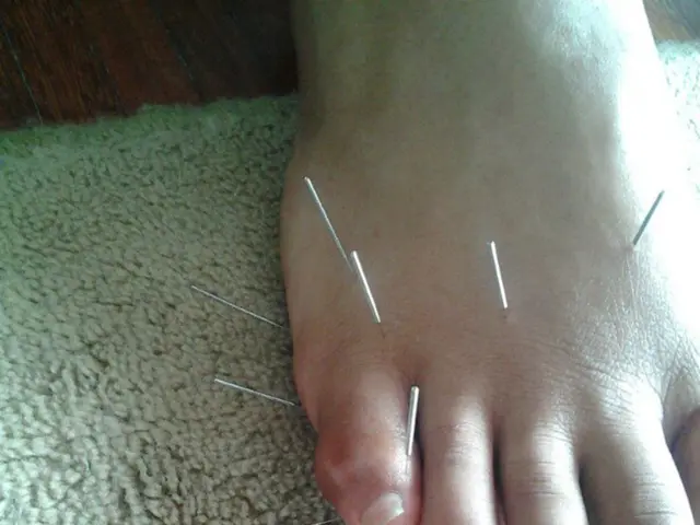 Symptoms and remedies for discomfort caused by varicose veins