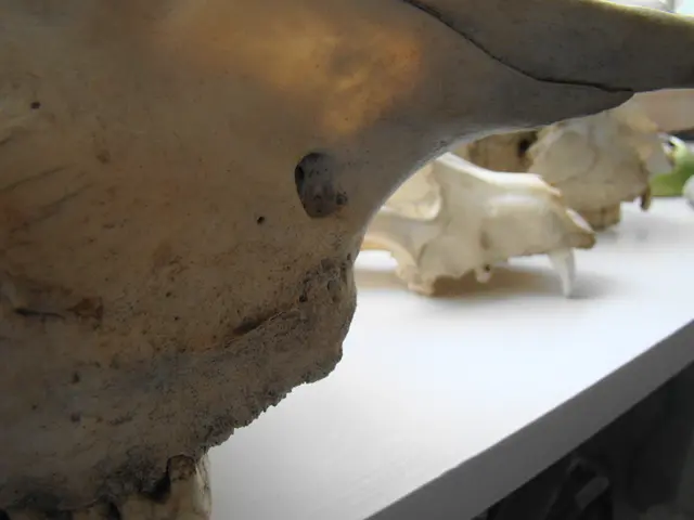 Brain tumor, specifically a type known as Meningioma