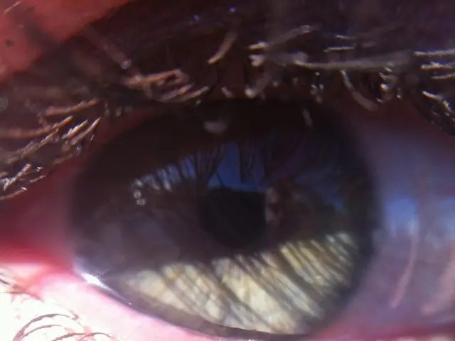 Reasons for Teary Eye Discharge in Dry Eyes